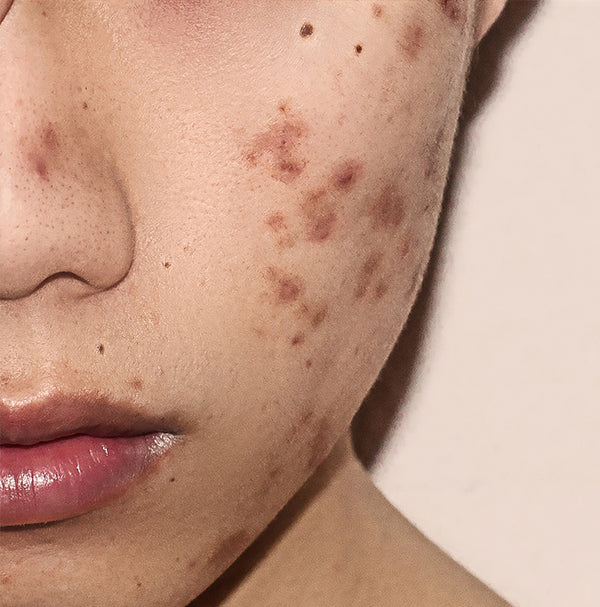 Acne: What are the different types?
