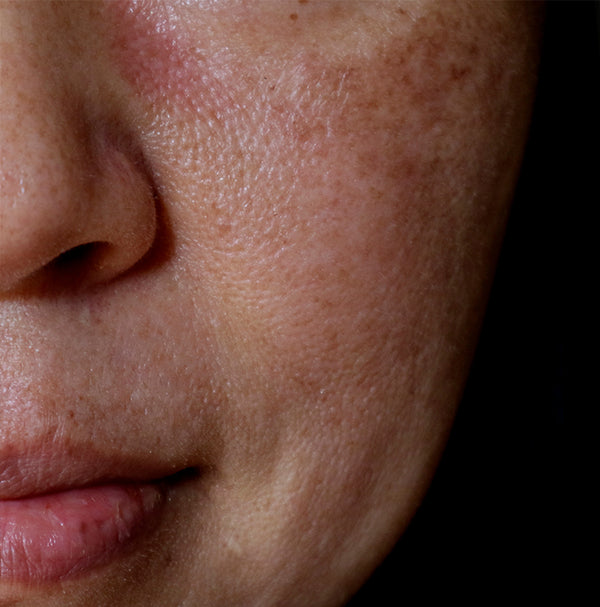 What are the types of Hyperpigmentation?
