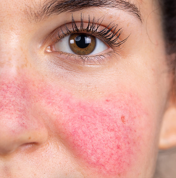 More than a red face: Rosacea