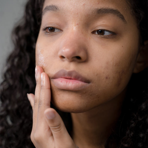 Got rid of your acne... Now what?